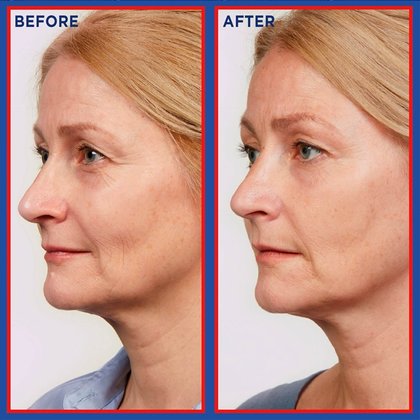 Serum Before And After